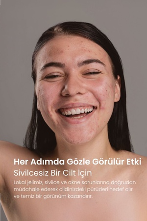 Akne Karşıtı Kurutucu Lokal Jel 30 ml