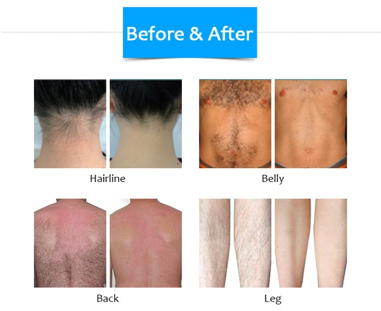 60% скидка! Тройной волновой ледяной титановый платиновый/ 755 1064 808 нм диодные лазерные волосы удаление/ александритная лазерная машина для удаления волос